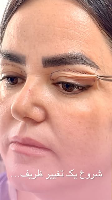 ⁨	⁨	⁨	⁨	⁨	چرا بعضی افراد بعد عمل بلفاروپلاستی چشماشون موقع خواب باز میمونه یا دچار خشکی چشم میشن؟🧐 