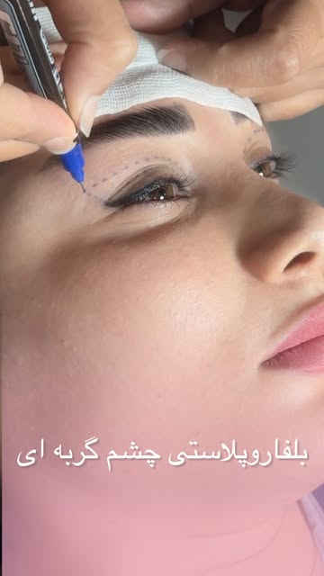 ⁨	چشم‌هاش چرا اینقدر کشیده و جذاب شدن؟ 👀✨

بلفاروپلاستی چشم گربه‌ای می‌تونه با اصلاح فرم پلک و ایجا