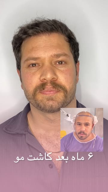 ⁨	⁨	ببخشید خیلی خوب نمیتونست فارسی صحبت کنه🤗🤭☺️
۶ماه بعد کاشت موی سوپر اف یو ای پلاس
کاشت تضمینی د