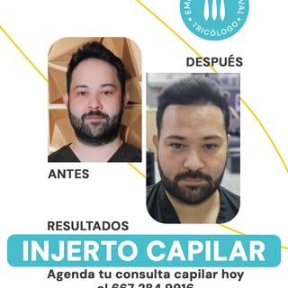 Yo también estuve en tu lugar.
Decidí confiar  y hoy llevo conmigo el resultado de un injerto capila