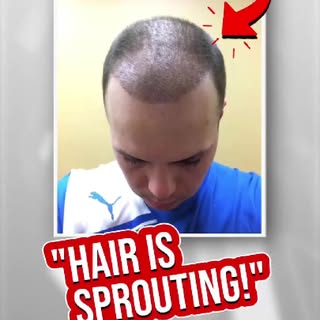 Andrew is only halfway through his growth timeline after his FUE at @Restore_Hair and he already lov