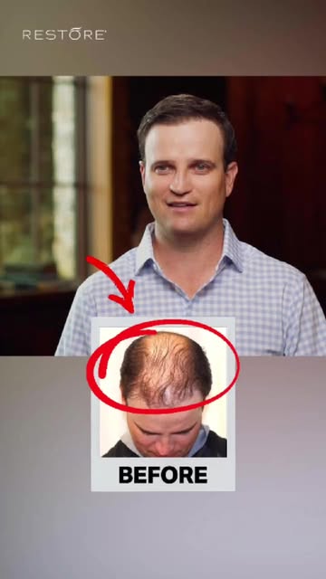 Can hair transplant results start becoming noticeable within just a few weeks? 👀

PGA star Zach Joh
