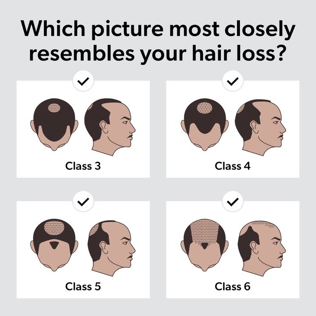 Hair loss looks different for everyone- but knowing where you are is the first step.

Which Norwood 