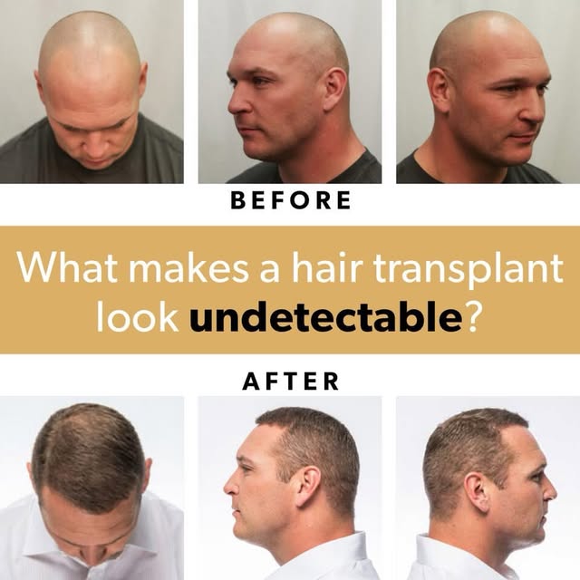The goal? Hair that looks so natural, no one knows you had a transplant. From hairline design to gra