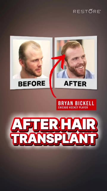 Bryan Bickell went from hair loss to loving his haircuts after his FUE at @Restore_Hair. Follicles m