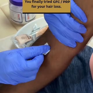 Say goodbye to thinning hair and hello to natural hair regrowth! 🌿✨

Growth Factor Concentrate (GFC