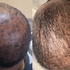 THE SCALP IS LIVING SKIN

The scalp is an extension of the skin and the environment where hair folli