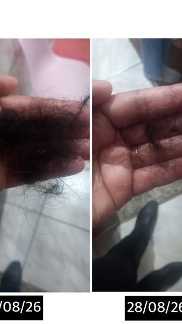 Cabelo caindo? Pare de gastar dinheiro tentando acertar o tratamento sozinha.
Queda capilar pode ter