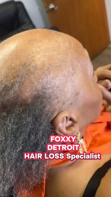 THIS is why I say you have options. ✨

Extensive hair loss doesn’t mean you have to settle for a sty
