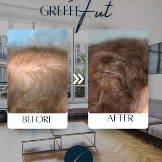 Avant / Après ✨⁣
⁣
Un cuir chevelu clairsemé, des cheveux qui s’affinent…⁣
➡️ Une seule séance de gr