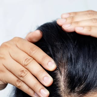 🔍 Alopécie féminine : comprendre pour mieux traiter.⁣
⁣
Changements hormonaux, stress, carences, po