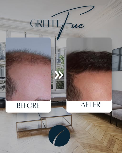 ✨ Avant / Après — Greffe capillaire FUE⁣
Ce patient de 35 ans présentait une alopécie androgénétique