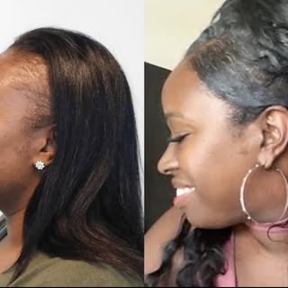 ✨ From Hair Loss to Confidence Restored! ✨

Check out this incredible before-and-after transformatio