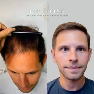 Swipe to see this incredible transformation by Dr. Rose! 🌟

.

My patient’s journey showcases the l