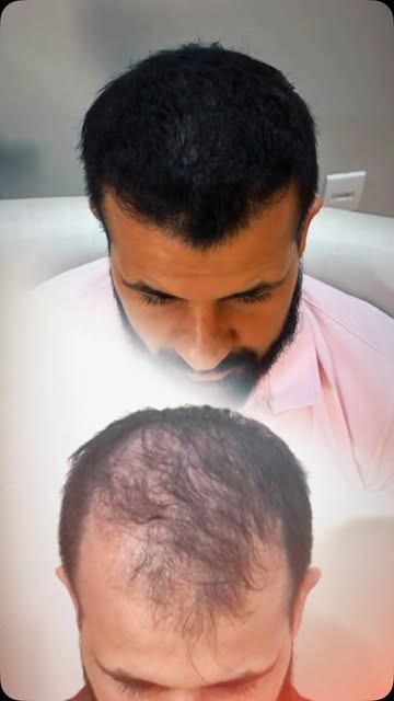 Você diria que esse cabelo veio de um transplante capilar?! Além da alta densidade que este paciente