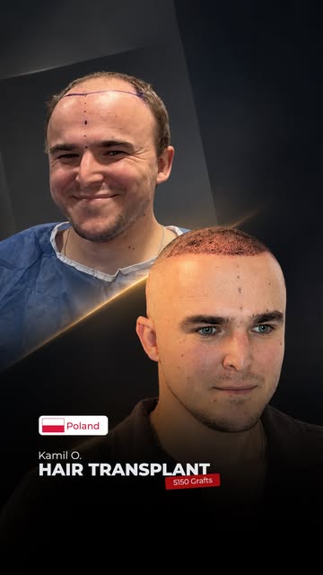 5150 grafts were implanted during the procedure. @kamil.osypowicz 

Take advantage of our limited-ti