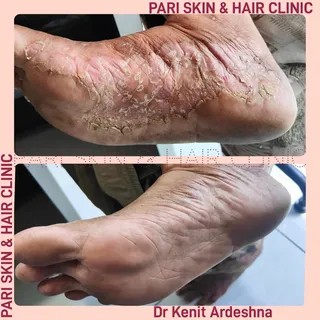 #happypatient 

🩺 Dr. Kenit Ardeshna
🧚 PARI SKIN & HAIR CLINIC
🌍 RK Prime PLUS, Nr. Balaji hall, 