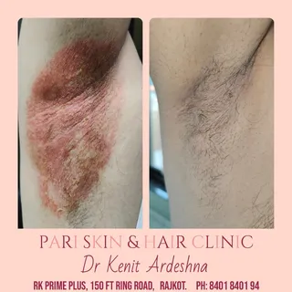 #erythrasma #happypatient 

🩺 Dr. Kenit Ardeshna
🧚 PARI SKIN & HAIR CLINIC
🌍 RK Prime PLUS, Nr. B