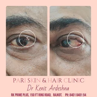Wart, a HPV (virus) infection, over an eyelash, an extremely difficult site, removed successfully by