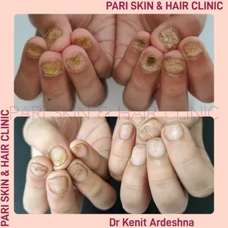 Trachyonychia or in simple language rough sand-paper nails in a child is very rare and difficult to 