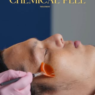 Erase Acne Marks & Pigmentation With a Professional Chemical Peel. 

Stubborn dark spots and post ac