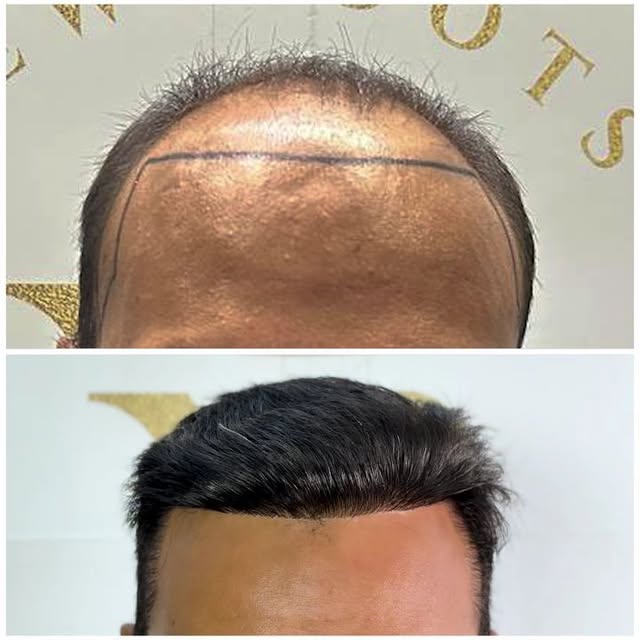 The Power of Transformation: Hair Transplant Before & After 

When hair loss starts affecting your c