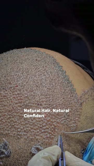 ✨ FULL HEAD HAIR TRANSPLANT ✨
From hair loss to a natural-looking transformation.
🌱 Advanced Hair T