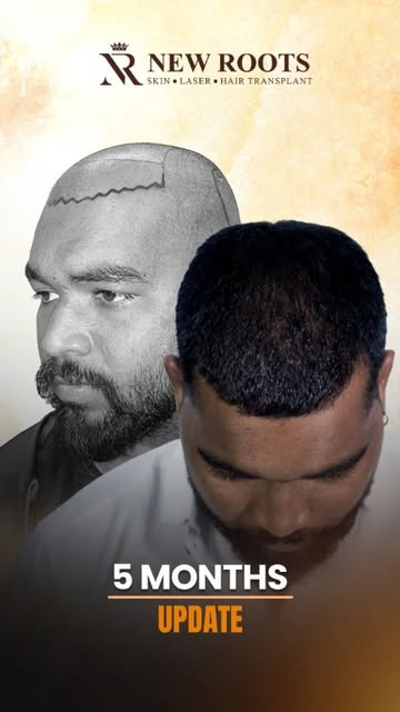 ✨ 5 MONTHS HAIR TRANSPLANT RESULT ✨
🌱 Grafts: 5000
⭐ Grade: 5
💉 1st PRP Session

5 Months of Growt