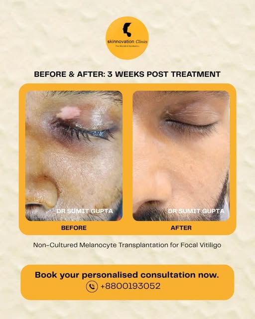 A closer look at the visible change following treatment, with repigmentation appearing in the treate