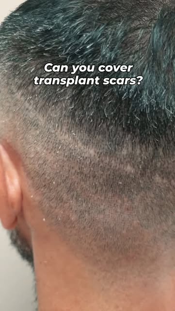 Hair transplant scar coverage made easy with hair tattoo 🔥

📍 Established 2011 | Gold Coast, Austr