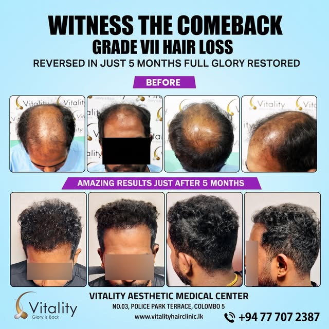 [REPOST] Witness the ultimate comeback!  Incredible results showing Grade VII hair loss reversed in 
