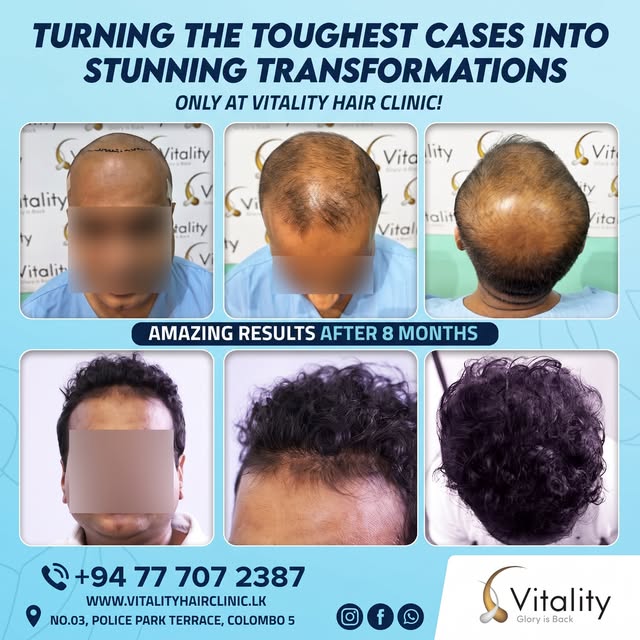(REPOST) Turning the toughest cases into stunning transformations! 💙
Check out these amazing result