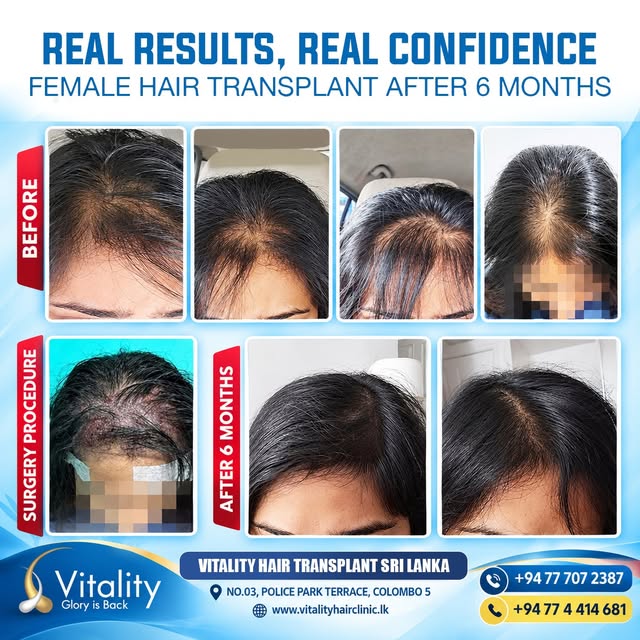[Repost] Natural Hairline Restoration with Unshaven Hair Transplant for Female Pattern Hair Loss

 R