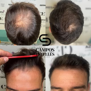 ✨ RECUPERA TU CABELLO. RECUPERA TU CONFIANZA.✨

Este cambio no es casualidad.
Es el resultado de un 