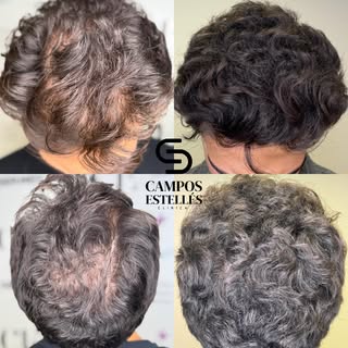 ✨ Recupera tu cabello. Recupera tu confianza.

Cada caso es único, por eso en Clínica Campos Estellé