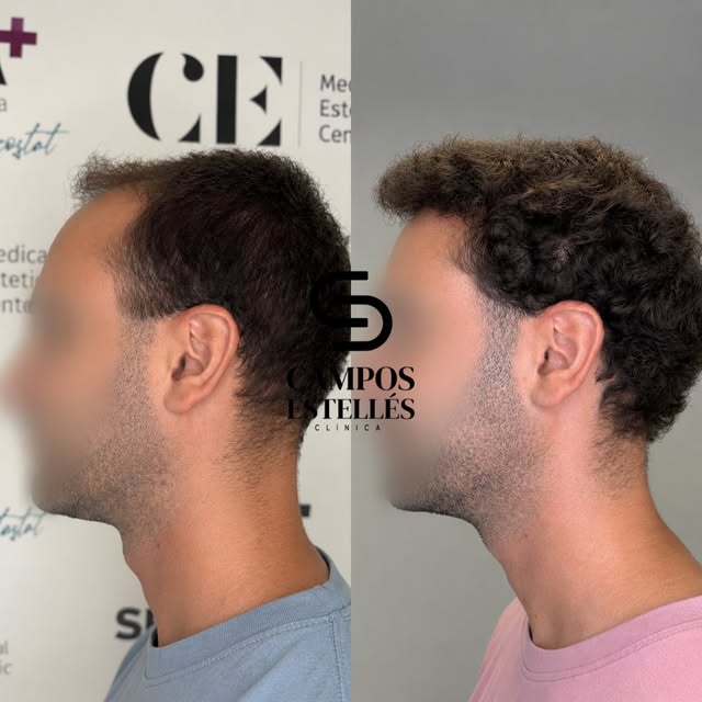 CASO DE ÉXITO | CIRUGÍA CAPILAR ✨

Un cambio que no busca parecer artificial.
Busca recuperar densid