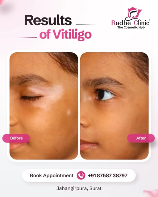 Seeing white patches on your skin? Early diagnosis makes all the difference—look at this transformat