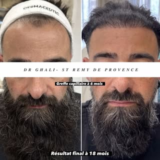 ✨ Résultat à 6 mois après une greffe capillaire.

À ce stade, la repousse est déjà bien visible et p