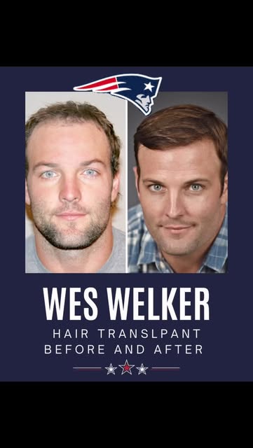 Wes Welker came to Leonard Hair Transplant Associates ready to take back control of his hairline and