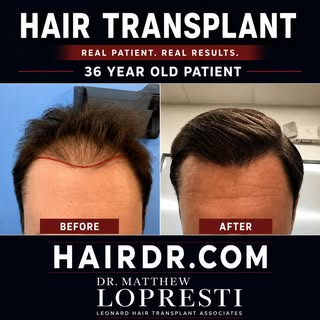 36 years old. One hair transplant. A lasting difference. 💪 

#HairTransplant #HairRestoration #Befo