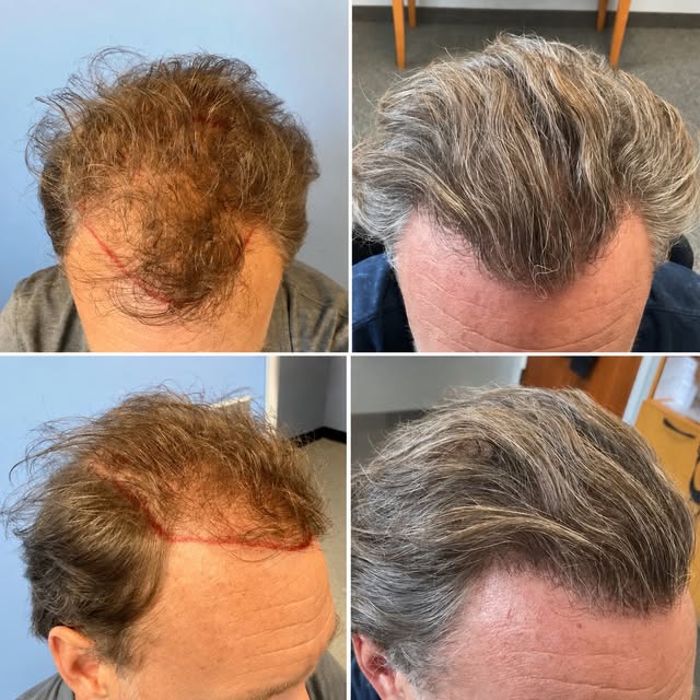 19 months later. 👀 The difference is hard to miss.

51 years old and 19 months after his hair trans