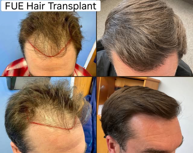 Hair loss didn’t get the final say for this 36-year old patient!

FUE hair transplant by @dr.matthew