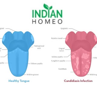 Mouth fungal infection Stomatitis Oral Candidiasis and Oral thrush Homeopathy Treatment

Read More: 