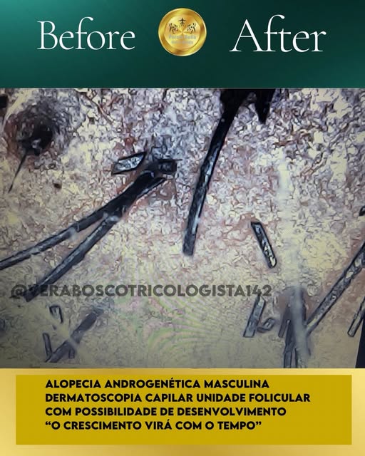 🔎 Dermatoscopia De Couro Cabeludo Alopecia Androgenética Masculina 

🔎Unidades Foliculares Ativas 