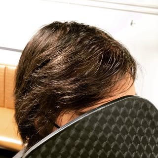 There is no immediate solution for Alopecia Areata but there are ways to manage how you look and fee