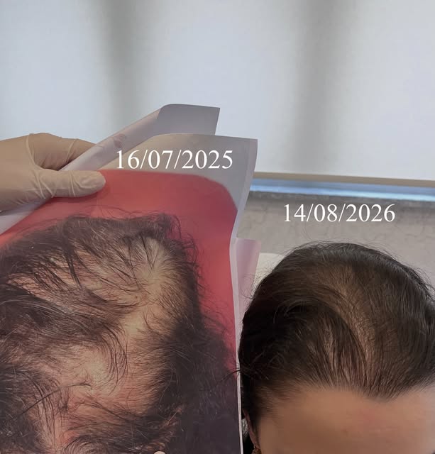 Saç dökülmesine karşı kişiye özel yaklaşım. ✨
Doğru analiz, doğru tedavi ve düzenli takip ile saçın 