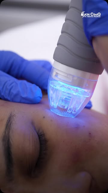 Acne scars. Fine lines. Uneven texture. Dullness. Most people assume each of these needs a completel
