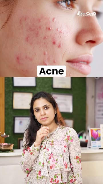 Red bumps on your face are not always acne.

Acne, Folliculitis and Pityrosporum Folliculitis can lo