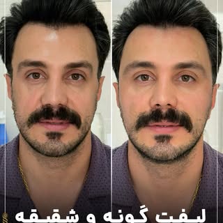 ⁨	⁨	تکنیک لیفت صورتی که براتون انجام میدیم  همون تغییر سوسکیه هست که دنبالشین ولی حسابی روی زیباتر ش