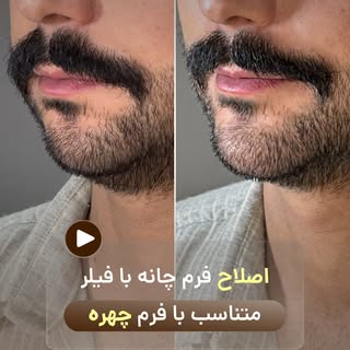 فیلر چانه یا ساکشن غبغب مسئله این است🤷🏻‍♀️🫣
.
وقتی چانه با تکنیک اصولی و فیلر مرغوب تزریق بشه غیر